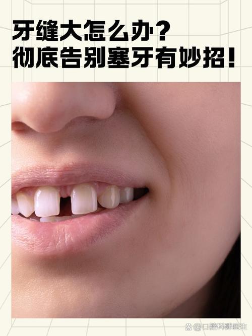 正畸N年后大牙缝，是矫正问题还是其他原因？-图3