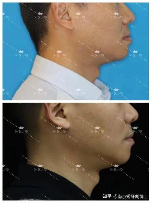 正畸反颌矫正病历,矫正效果与过程如何体现?-图3 正畸反颌矫正病历,矫正效果与过程如何体现?-图3