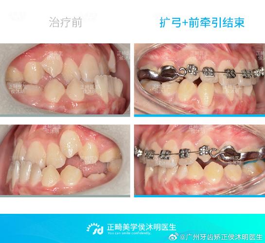 正畸中拱形效应如何实现牙齿精准排列与移动？-图1