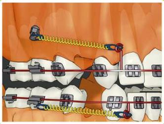 正畸五种常用支抗-图3