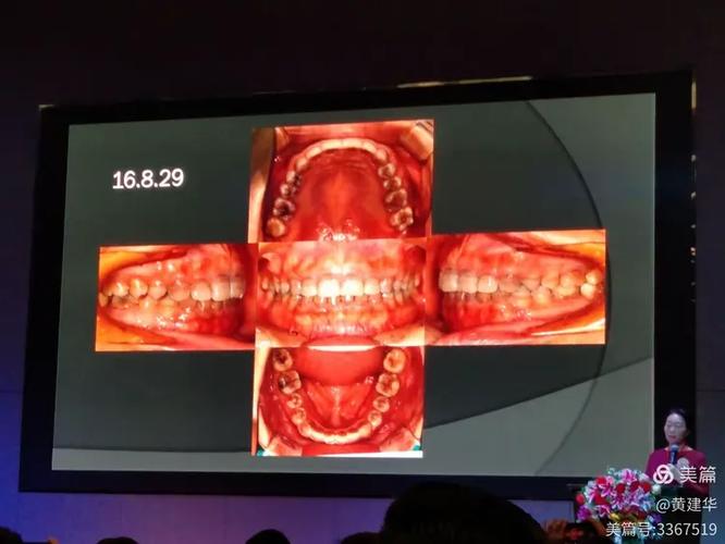 牙齿正畸 甘宝霞-图2 牙齿正畸 甘宝霞-图2