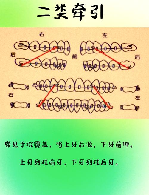 正畸弓丝左右滑动,原因是什么?影响矫正效果吗?-图1 正畸弓丝左右滑动,原因是什么?影响矫正效果吗?-图1