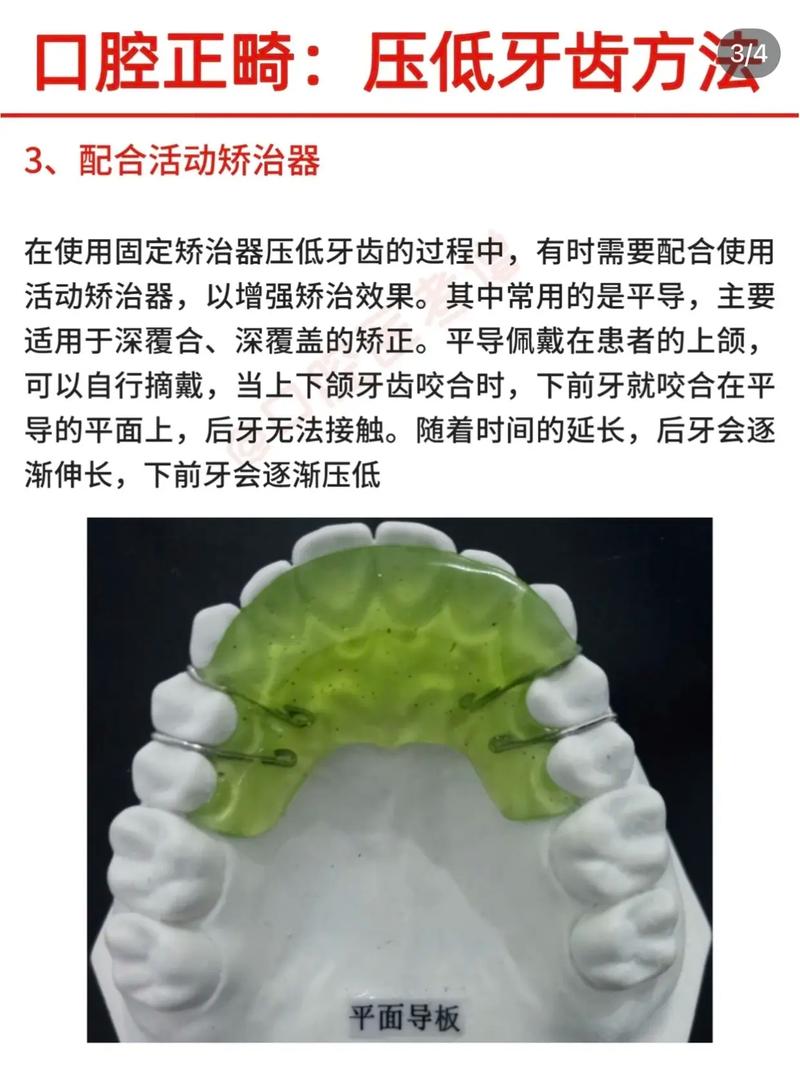 正畸摇椅怎么弯制-图3 正畸摇椅怎么弯制-图3