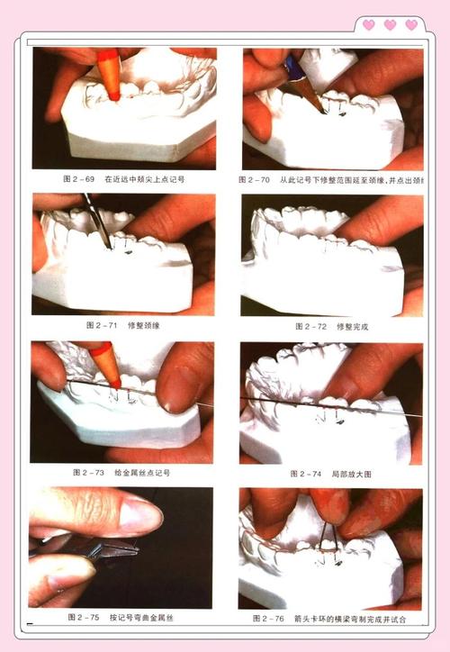 正畸单臂卡环弯制-图3