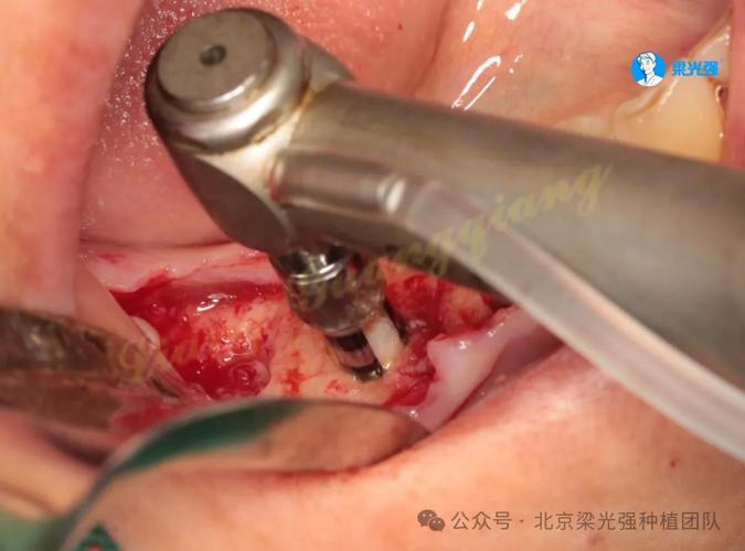 正畸前为何必须先做牙周治疗？-图1