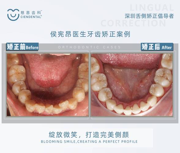 舌侧隐形正畸的隐形矫正原理是什么?如何实现精准移动?-图2 舌侧隐形正畸的隐形矫正原理是什么?如何实现精准移动?-图2