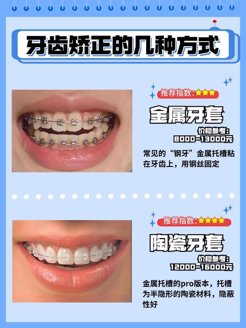 牙齿正畸牙套种类有哪些?如何挑选最适合自己的?-图1 牙齿正畸牙套种类有哪些?如何挑选最适合自己的?-图1
