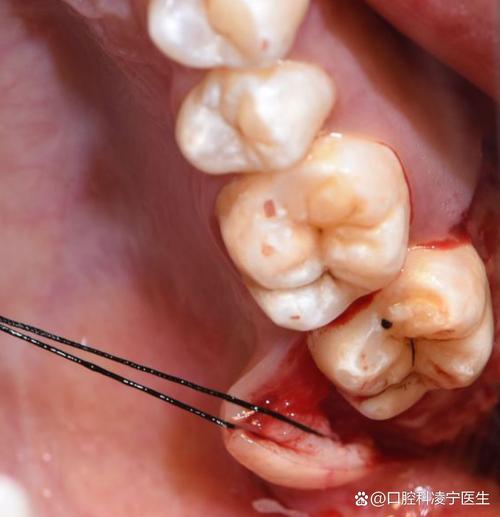 用智齿的位置正畸-图1