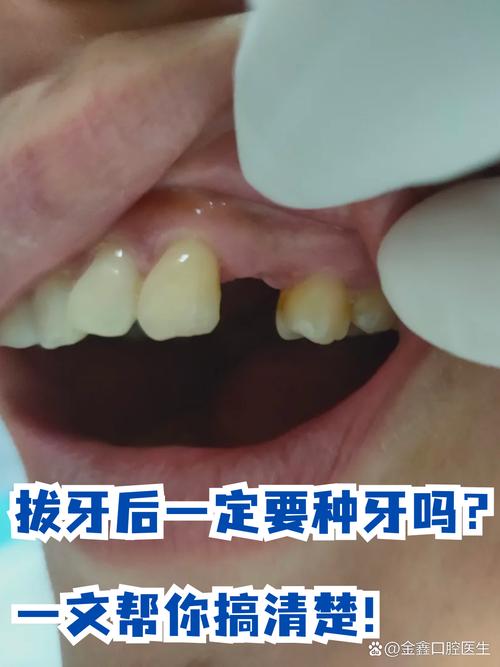 正畸拔牙后再种牙-图2