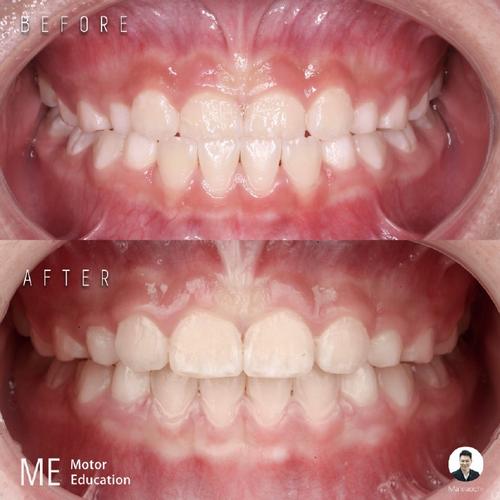 fr三型正畸技术-图2