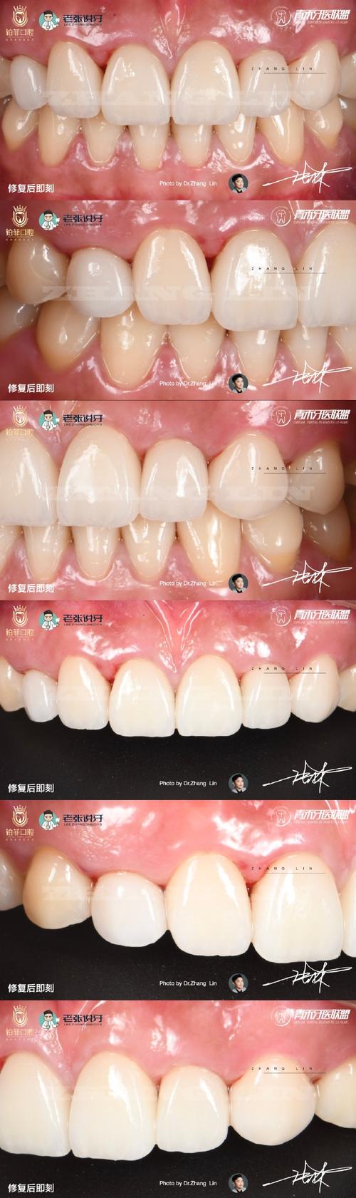 正畸期间补侧切牙可行吗?时机和材料选择要注意什么?-图2 正畸期间补侧切牙可行吗?时机和材料选择要注意什么?-图2