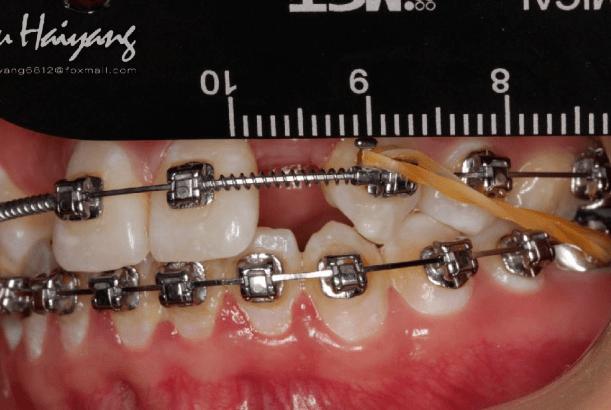 正畸期间补侧切牙可行吗?时机和材料选择要注意什么?-图3 正畸期间补侧切牙可行吗?时机和材料选择要注意什么?-图3