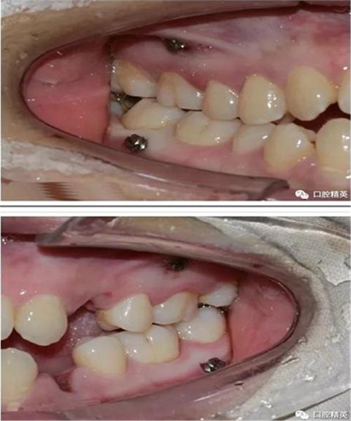 正畸种植钉的视频-图1