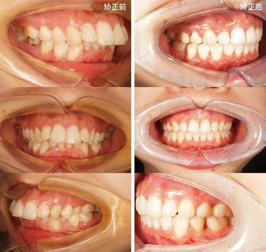 底面角可以正畸吗-图3