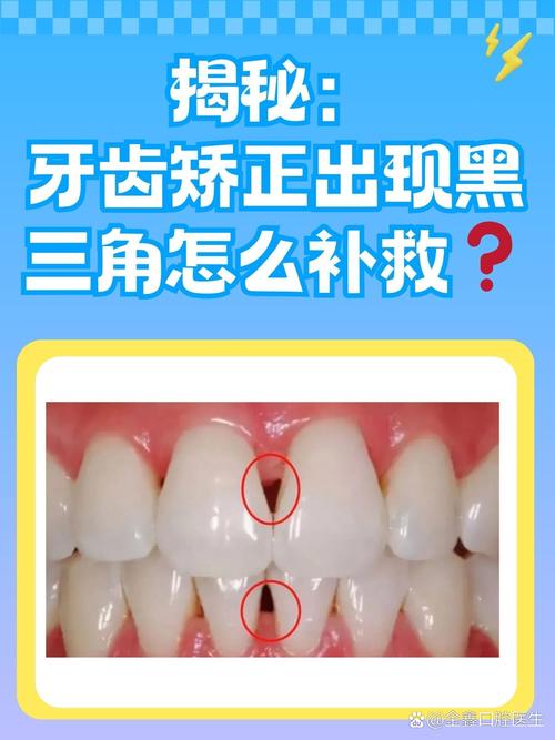 底面角可以正畸吗-图1
