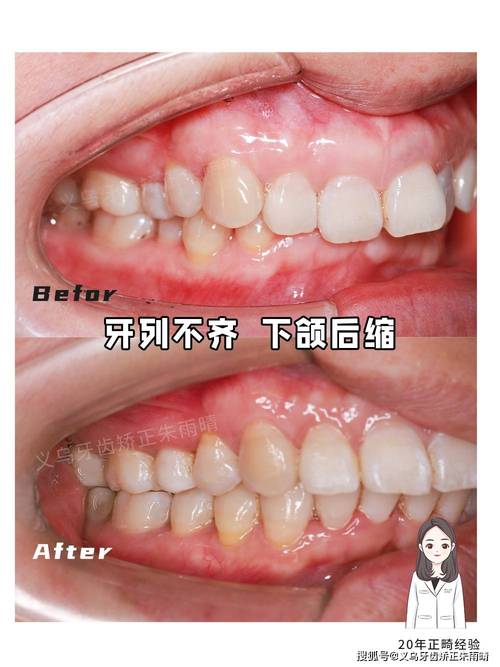 下颌骨矫正后正畸，作用与必要性是什么？-图2