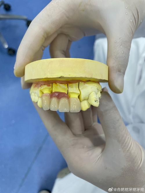 正畸陶瓷牙托脱落-图1 正畸陶瓷牙托脱落-图1