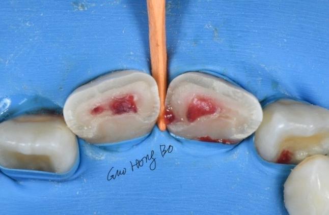 正畸陶瓷牙托脱落-图3 正畸陶瓷牙托脱落-图3