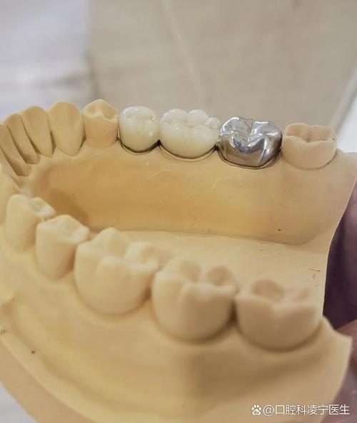 正畸陶瓷牙托脱落-图2 正畸陶瓷牙托脱落-图2