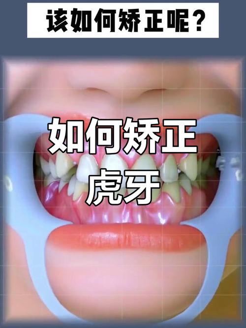 虎牙缺失影响美观?口腔正畸如何矫正?-图2 虎牙缺失影响美观?口腔正畸如何矫正?-图2