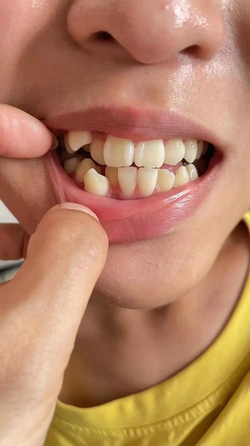 虎牙缺失影响美观?口腔正畸如何矫正?-图3 虎牙缺失影响美观?口腔正畸如何矫正?-图3