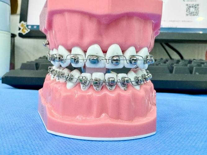 正畸压低辅弓应用-图3