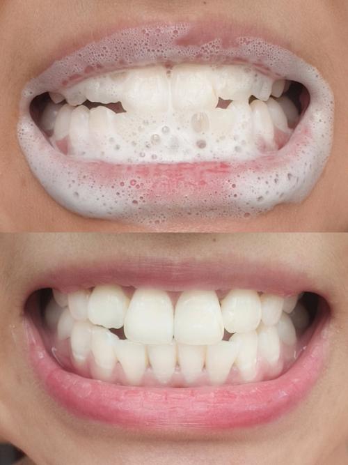 正畸牙根部位偏黄-图2 正畸牙根部位偏黄-图2