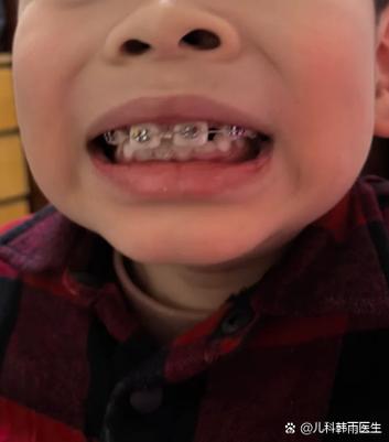 正畸牙根部位偏黄-图3 正畸牙根部位偏黄-图3