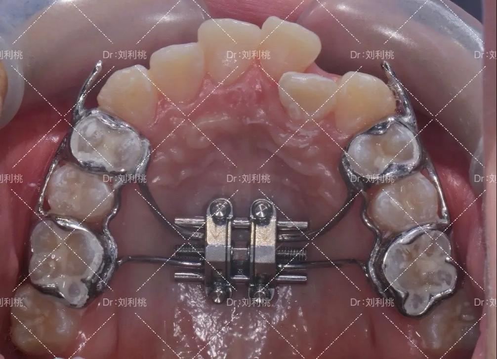 牙齿骨性正畸手术,骨性牙齿畸形矫正效果如何?-图1 牙齿骨性正畸手术,骨性牙齿畸形矫正效果如何?-图1