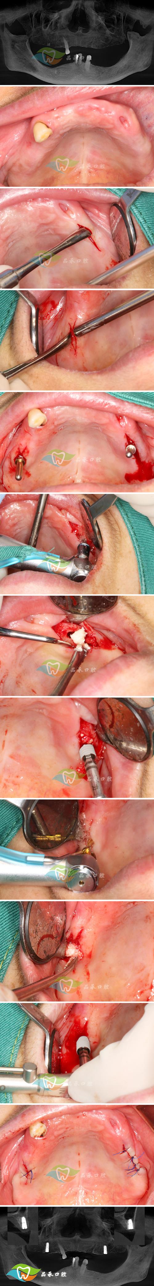 牙齿骨性正畸手术,骨性牙齿畸形矫正效果如何?-图2 牙齿骨性正畸手术,骨性牙齿畸形矫正效果如何?-图2