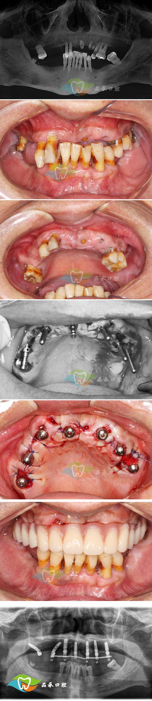 牙齿骨性正畸手术,骨性牙齿畸形矫正效果如何?-图3 牙齿骨性正畸手术,骨性牙齿畸形矫正效果如何?-图3