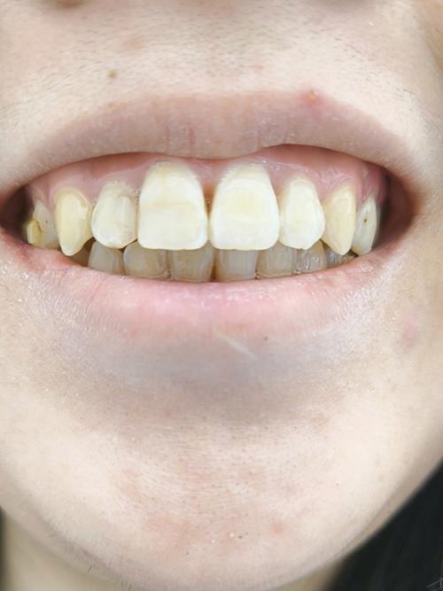 正畸牙齿出现灰线-图1