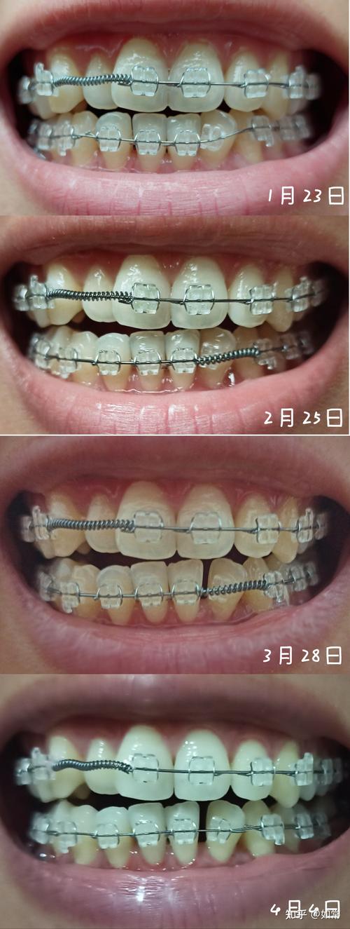成人口腔正畸图片-图3