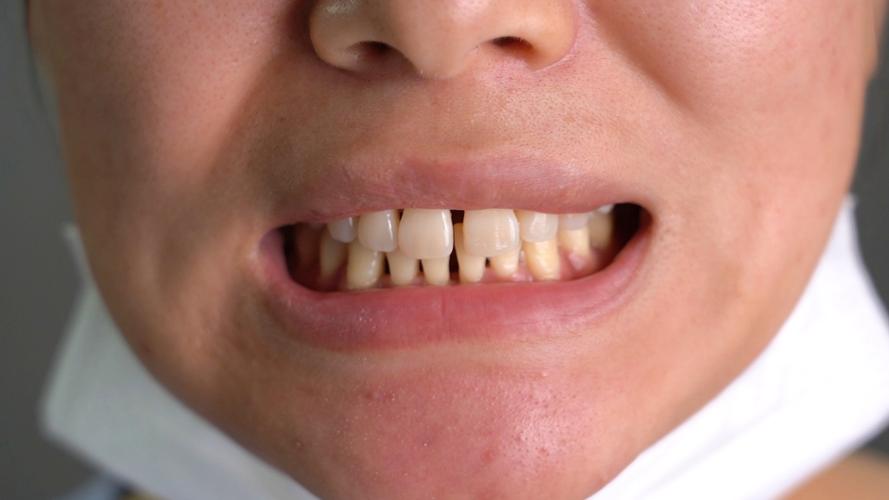 正畸下前牙骨开裂，原因是什么？如何预防与应对？-图1