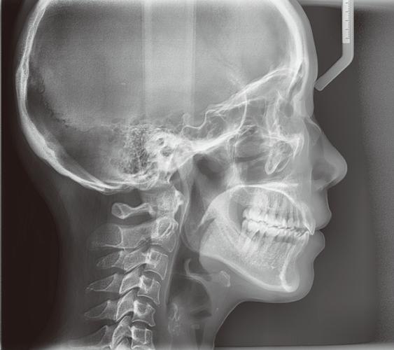 正畸头颅侧位软件-图1 正畸头颅侧位软件-图1