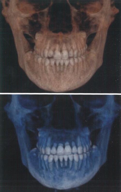 正畸治疗为何引发牙根吸收？如何预防与处理？-图1
