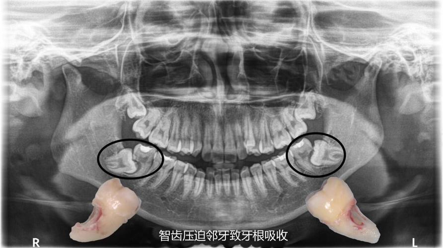 正畸治疗为何引发牙根吸收？如何预防与处理？-图2
