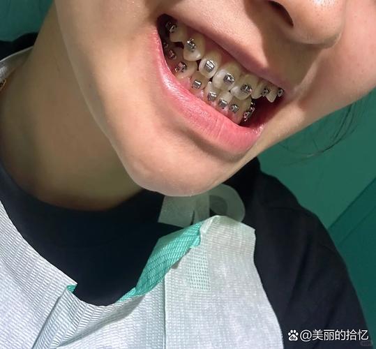 正畸中线歪得厉害，是什么原因导致的？-图1