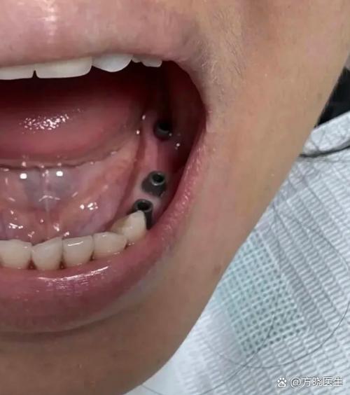 有牙周病能正畸吗-图3 有牙周病能正畸吗-图3