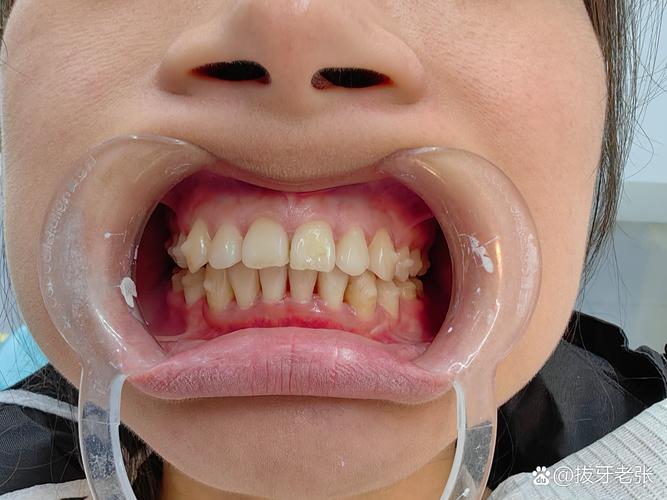 有牙周病能正畸吗-图2 有牙周病能正畸吗-图2