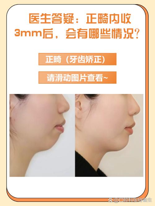 正畸内收过度图片-图2 正畸内收过度图片-图2