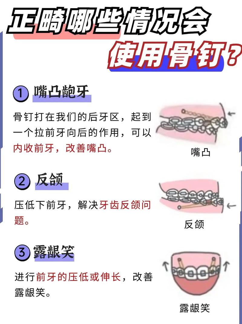 正畸拔牙不打骨钉-图2 正畸拔牙不打骨钉-图2