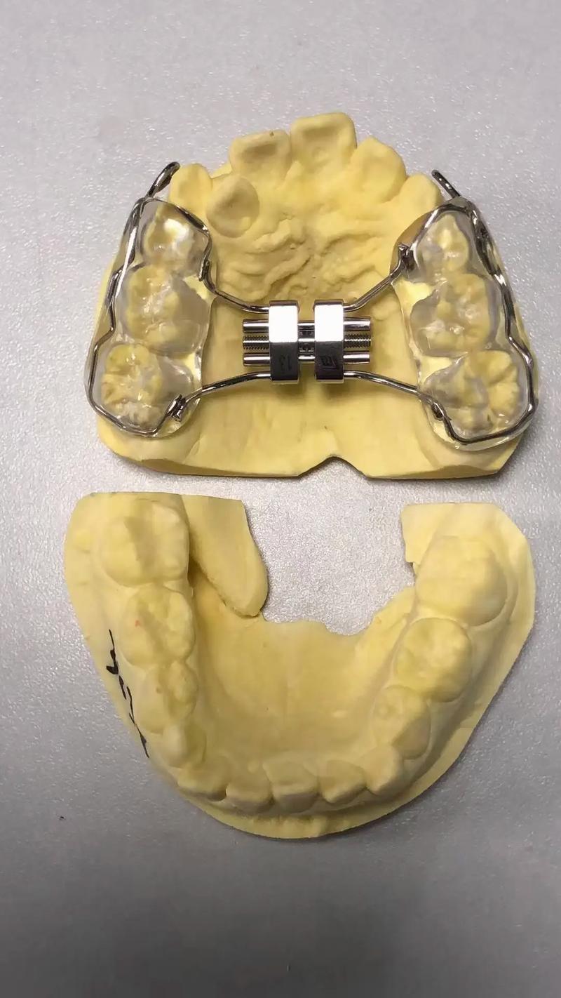 正畸粘结注意事项-图3 正畸粘结注意事项-图3