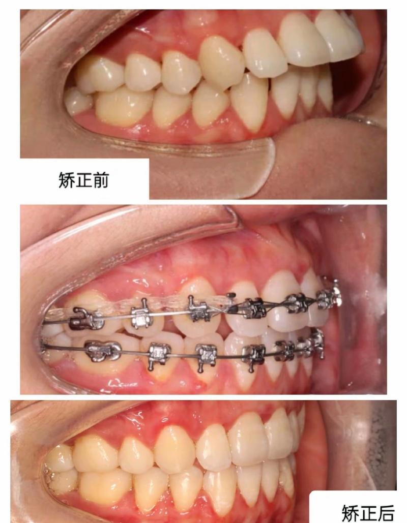 临时冠能支撑正畸-图2