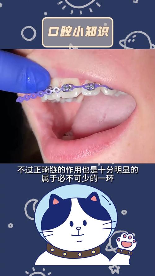 正畸橡皮链的清洁-图1 正畸橡皮链的清洁-图1