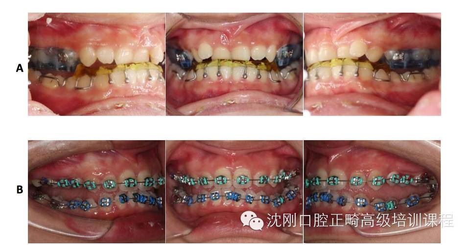 沈刚正畸分类视频-图1