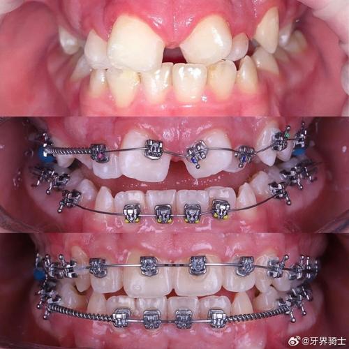 正畸要拍什么照片-图2 正畸要拍什么照片-图2