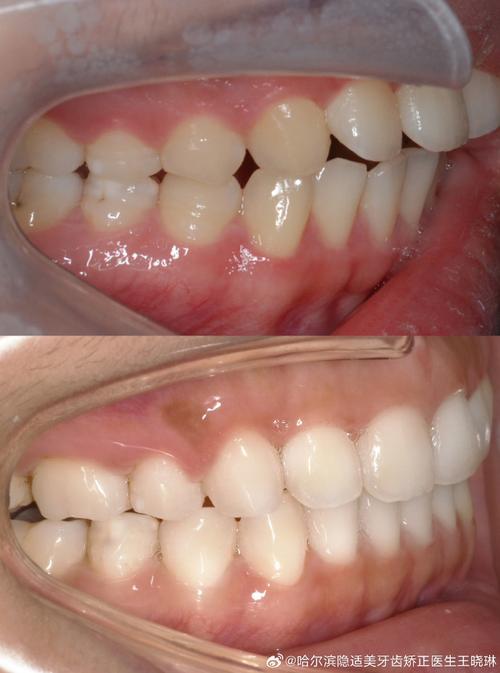 正畸之后去了外地-图1 正畸之后去了外地-图1