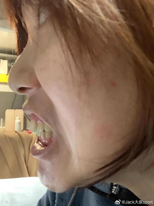 正畸之后去了外地-图2 正畸之后去了外地-图2