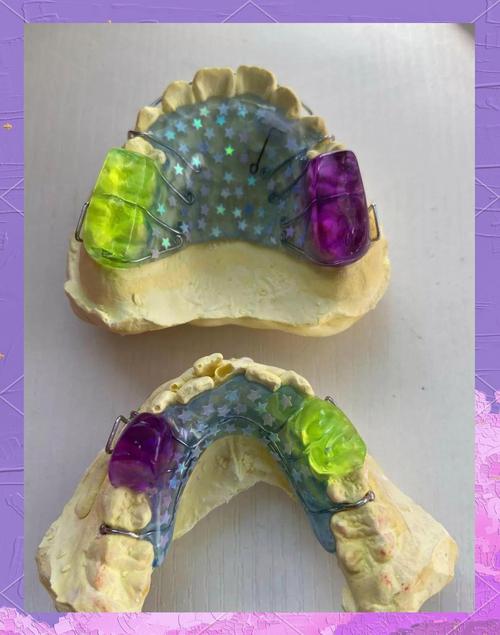 牙板固定之后正畸-图1